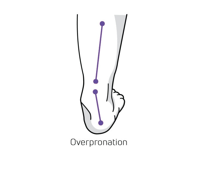 https://www.minfot.dk/pub_docs/files/Hurvetjagomjagpronerarellersupinerar/overpronation.jpg