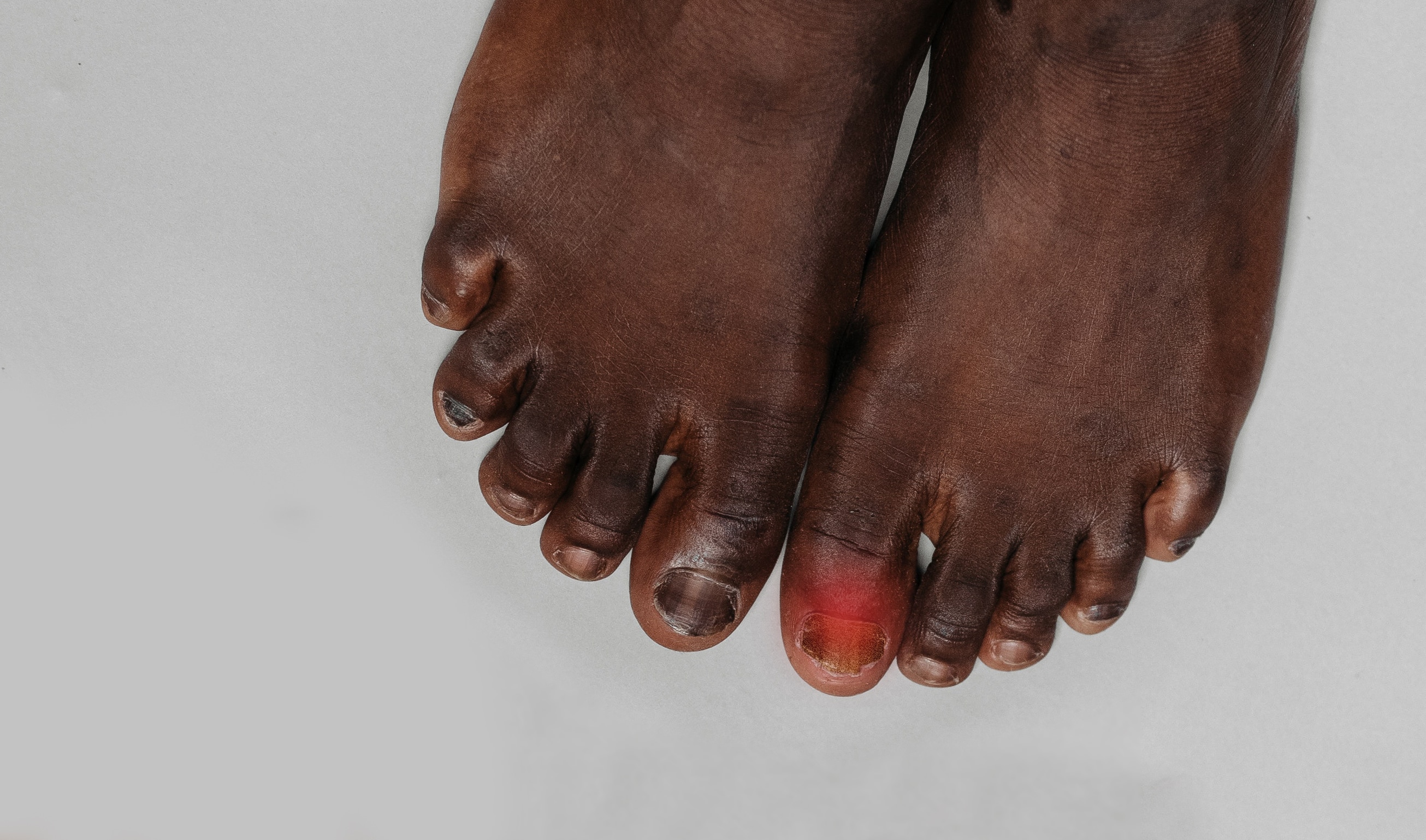 attribut Forhandle mm Hvad er mest effektivt mod fodsvamp?